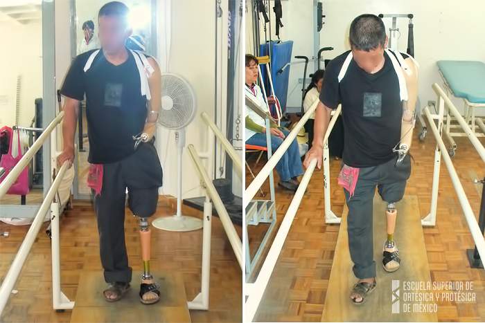 Atención a pacientes amputados